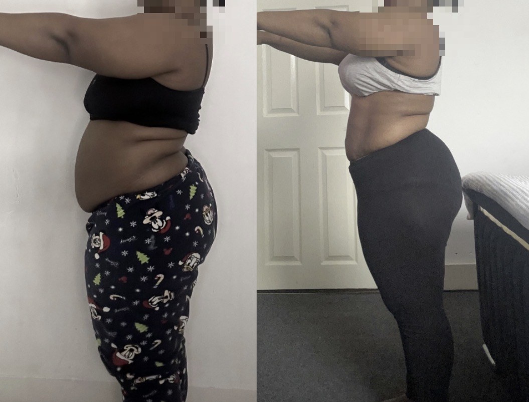 Before and after — 10-day method (face hidden for privacy)